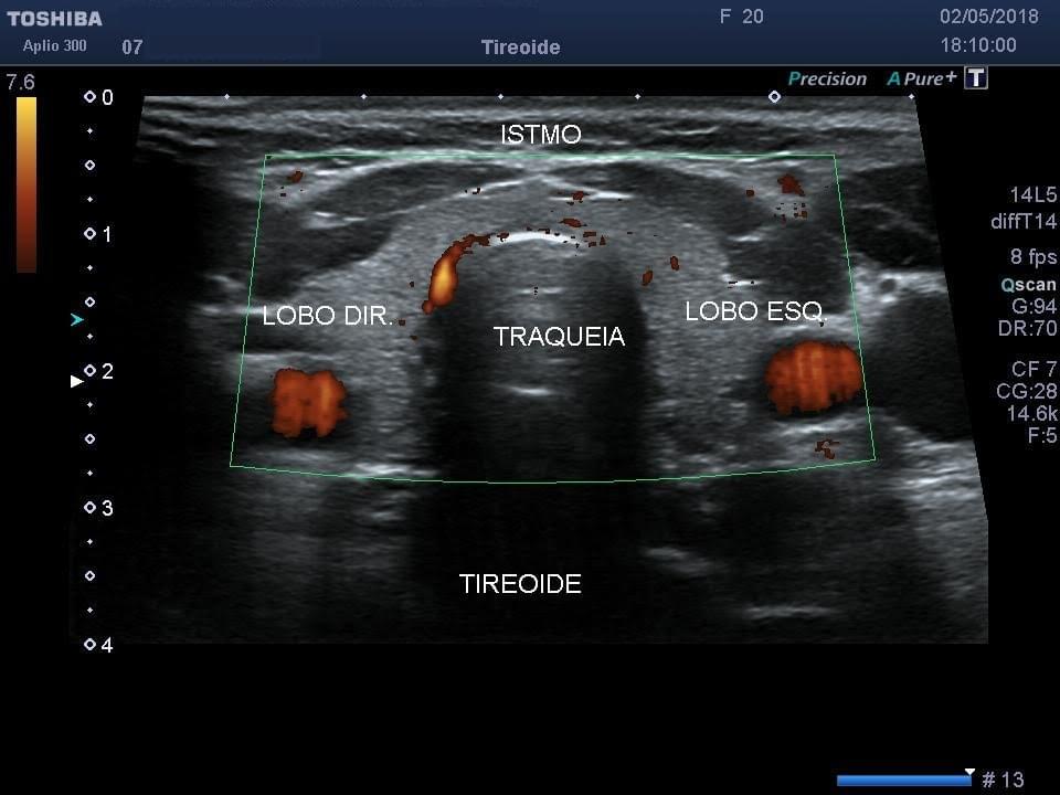 Diagnóstico de Ultrassonografia na Glândula Tireoide
